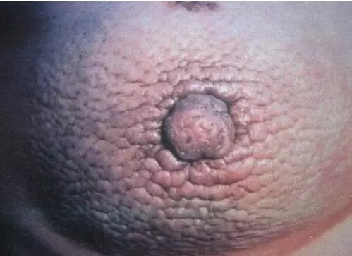 4张图认识乳腺癌早期症状