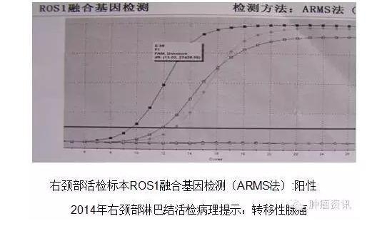 中日韩个体化诊疗案例大赛经典赏析之十——EGFR敏感突变患者，如果TKI原发性耐药，需警惕合并其他驱动基因变异！