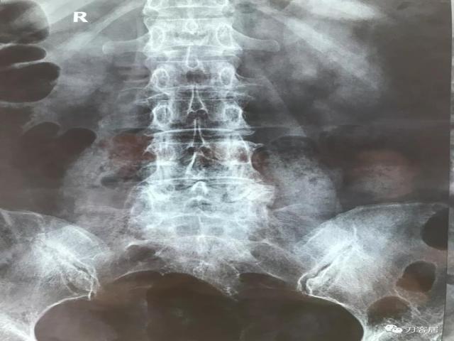 医生及患者通用:如何用手机翻拍X线片,磁共振片子,CT片子进行网络求医、病例讨论及保留资料 医生及患者通用:如何用手机翻拍X线片,磁共振片子,CT片子进行网络求医、病例讨论及保留资料