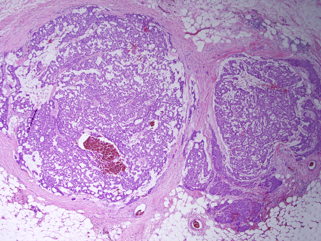 伴黏液的乳腺病变面面观-（二）黏液癌及黏液性囊腺癌