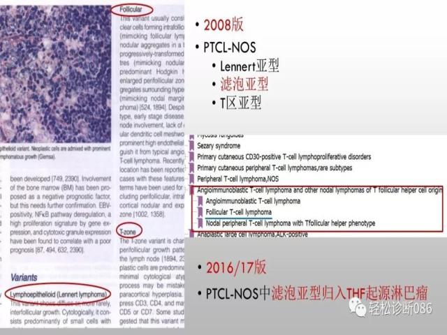 血管免疫母T细胞淋巴瘤的病理诊断