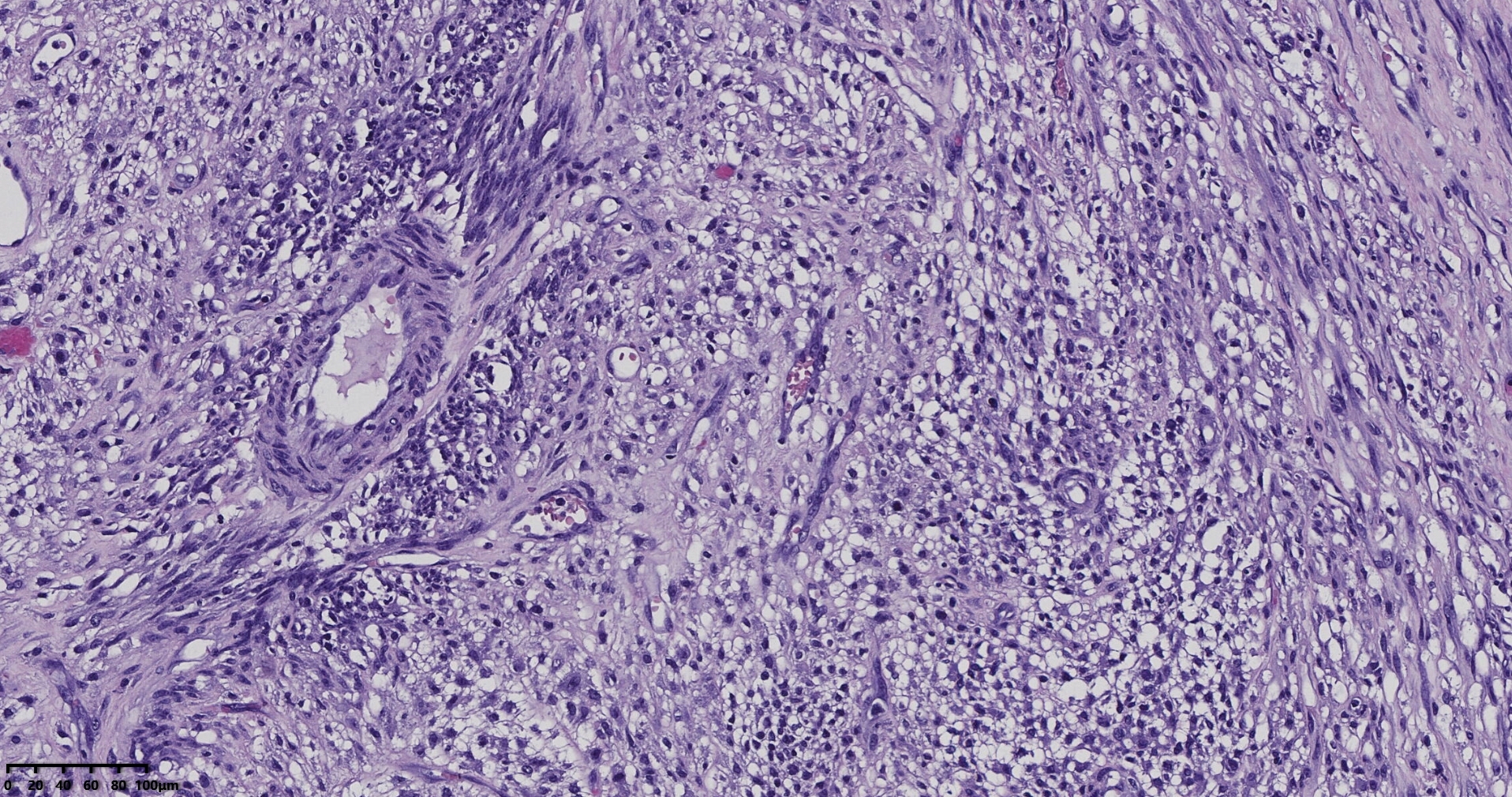 子宫多发性平滑肌瘤伴肉瘤