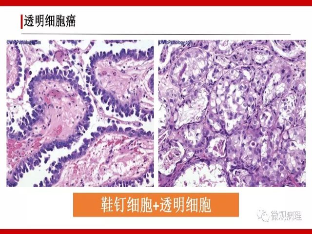 泌尿课程/尿路腺样病变的诊断要点