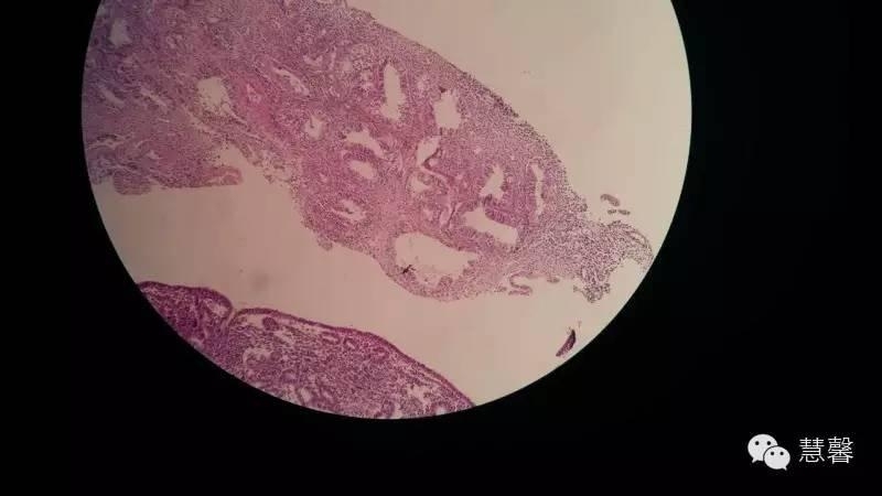 他莫昔芬相关性子宫内膜息肉（李慧娜分享，刘从容老师讲解）