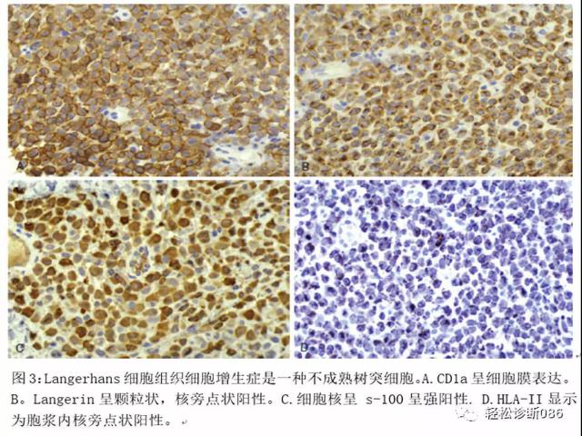 组织细胞起源疾病（3）——肿瘤性病变（LCH）