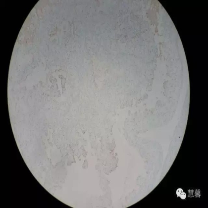 透明细胞乳头状肾细胞癌？TFE3 Traslocation Carcinoma？（赵洋分享，孔祥田(Max)*NM老师讲解）
