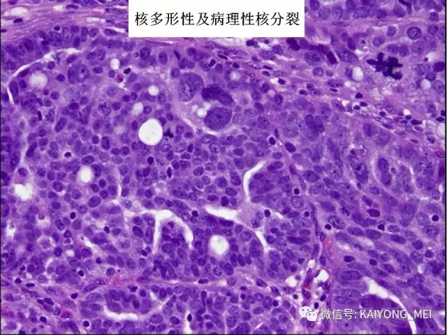 卵巢癌的病理诊断新进展（一）