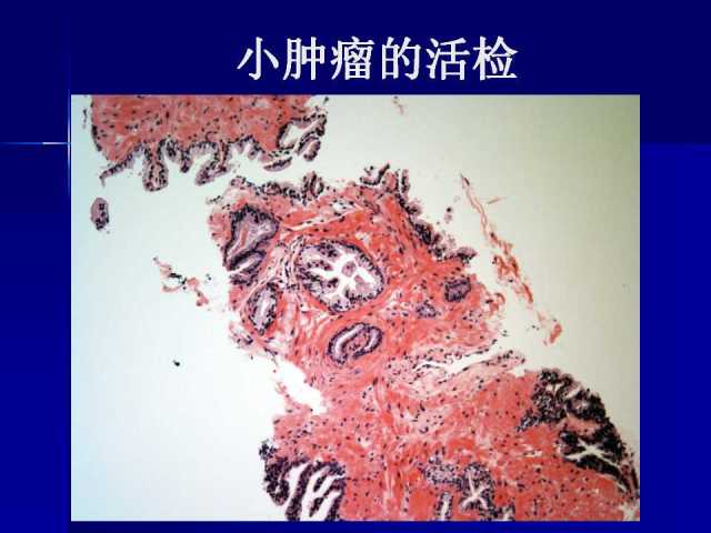 前列腺病理诊断线索（下）——黄教悌