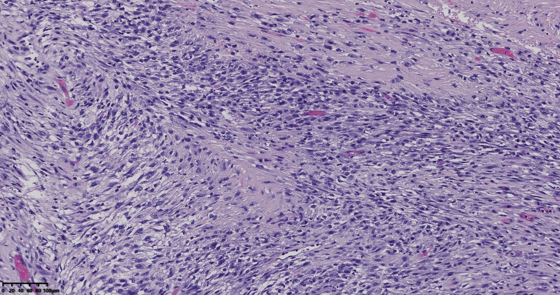 子宫多发性平滑肌瘤伴肉瘤