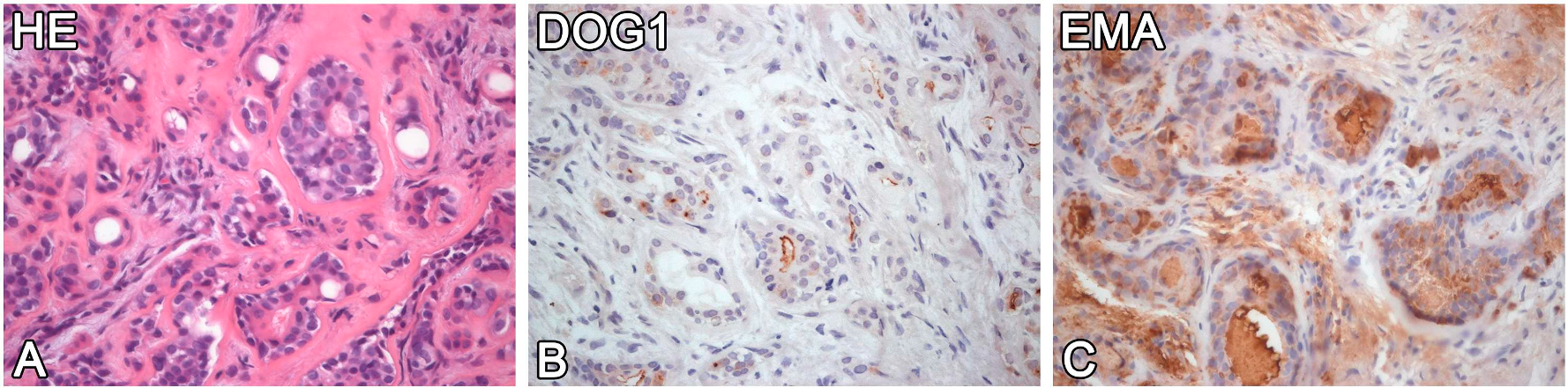 小涎腺肿瘤中EMA、DOG1免疫组化面面观