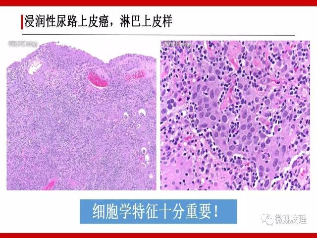 泌尿课程/浸润性尿路上皮癌病理学类型
