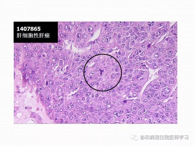病理学基础知识 : 核分裂像的识别