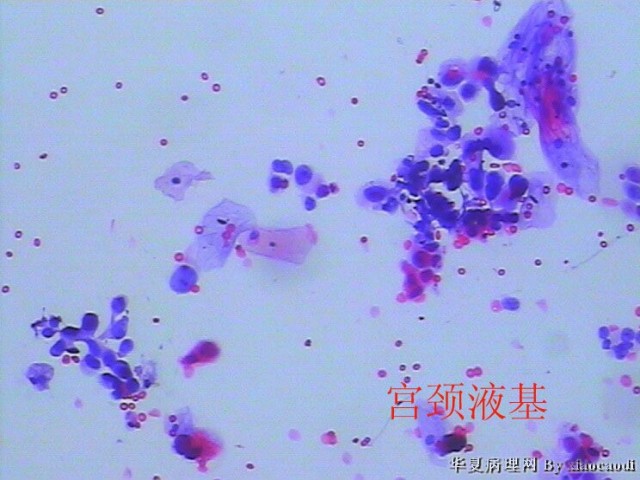 有奖读片病例整理：病例7 子宫内膜浆液性癌