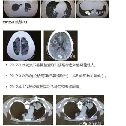 中日韩个体化诊疗案例大赛经典赏析之三——鳞癌诊断需警惕，二次活检为肺腺癌，EGFR 21exon突变，二线TKIPFS28月