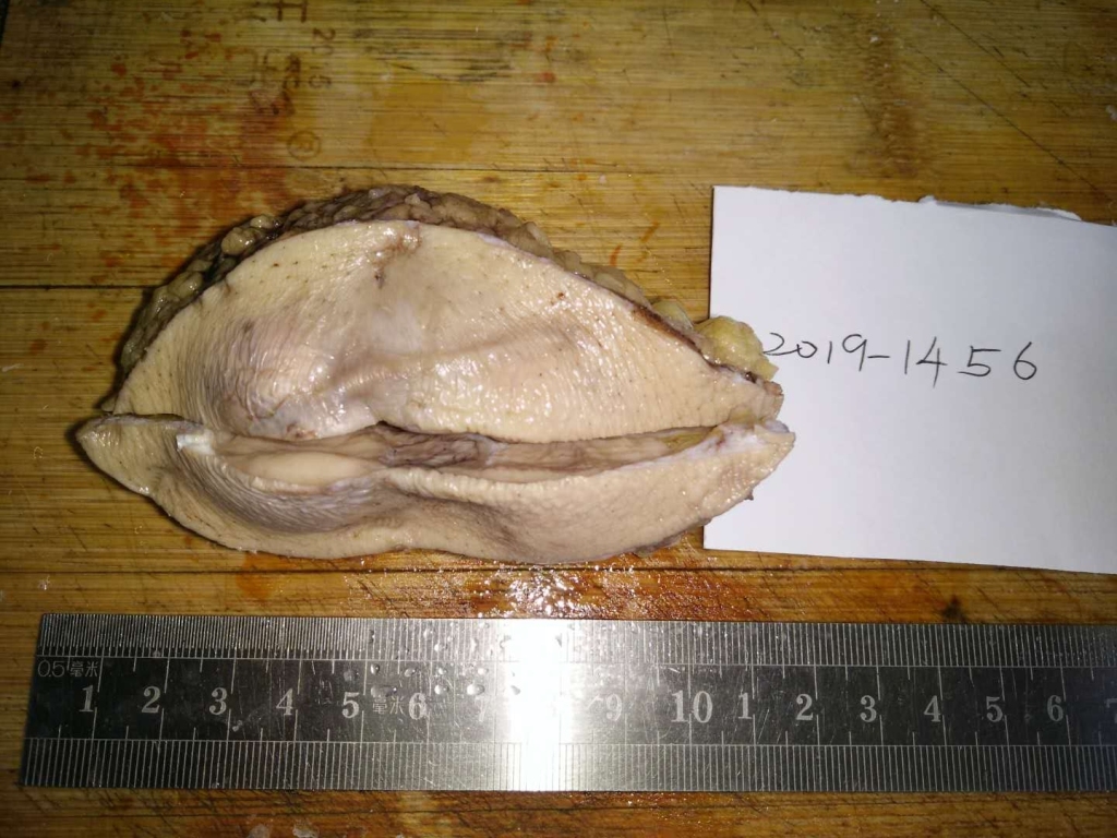 病理科工作札记（二十九）隆突性纤维肉瘤