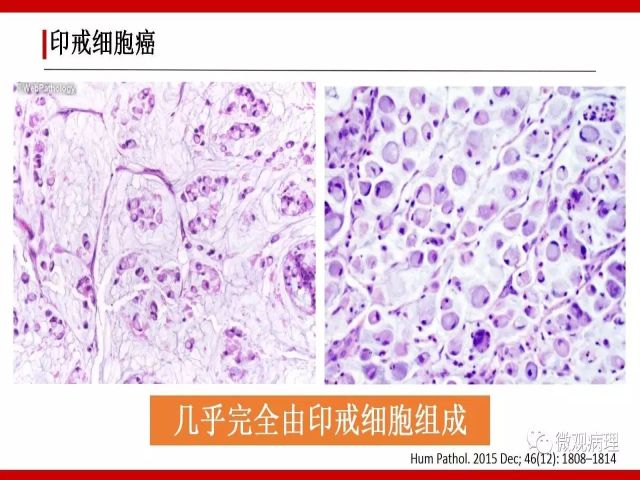 泌尿课程/尿路腺样病变的诊断要点