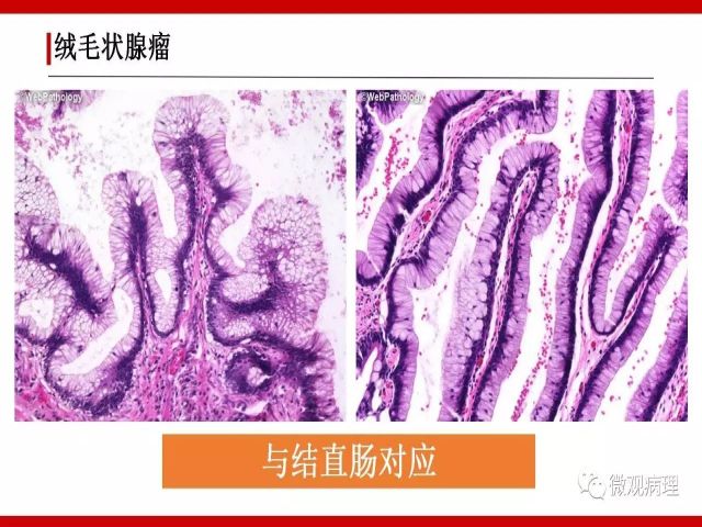 泌尿课程/尿路腺样病变的诊断要点