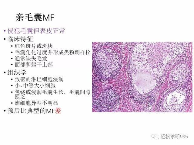 皮肤T细胞淋巴瘤