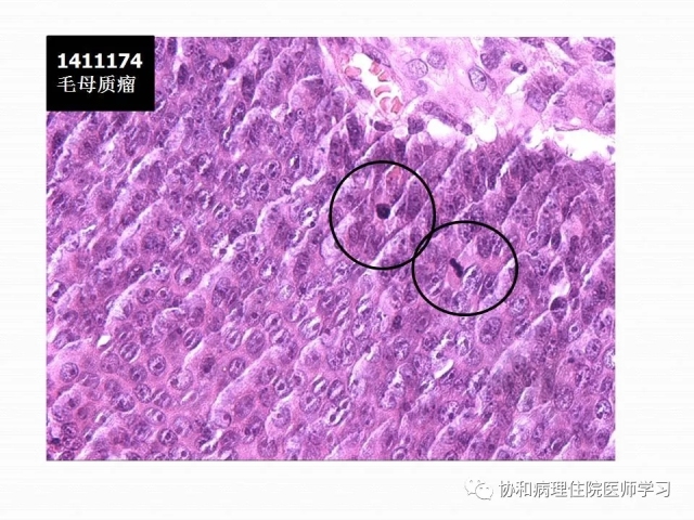病理学基础知识 : 核分裂像的识别