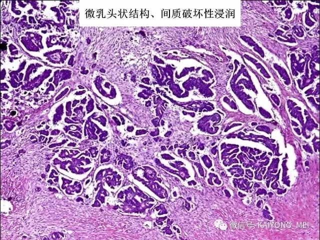 卵巢癌的病理诊断新进展（一）