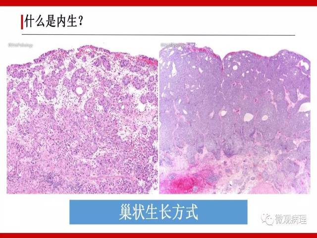 泌尿课程/尿路上皮病变的基本生长方式