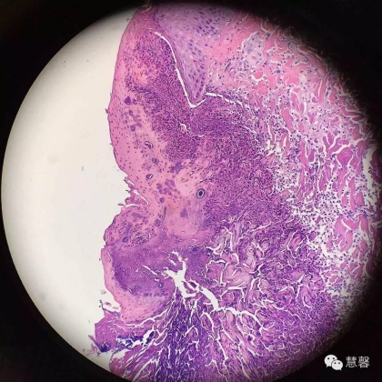 Acquired perforating dermatosis（孔祥田(Max)*Roswell*NM]分享及讲解）