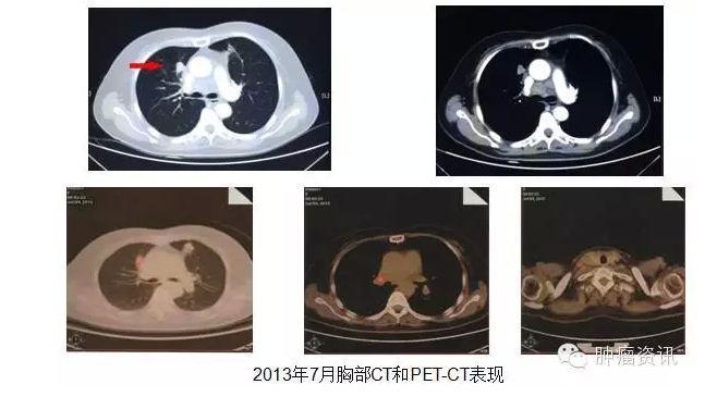 中日韩个体化诊疗案例大赛经典赏析之十——EGFR敏感突变患者，如果TKI原发性耐药，需警惕合并其他驱动基因变异！