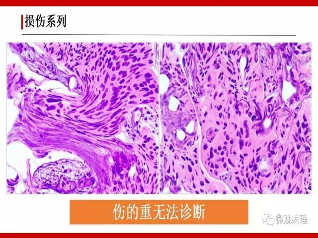泌尿课程/非浸润性尿路上皮病变诊断的一些困惑