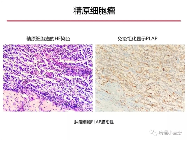 泌尿病理--精原细胞瘤VS精母细胞瘤