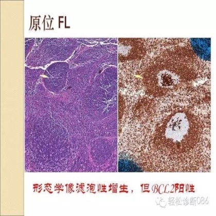 滤泡性淋巴瘤