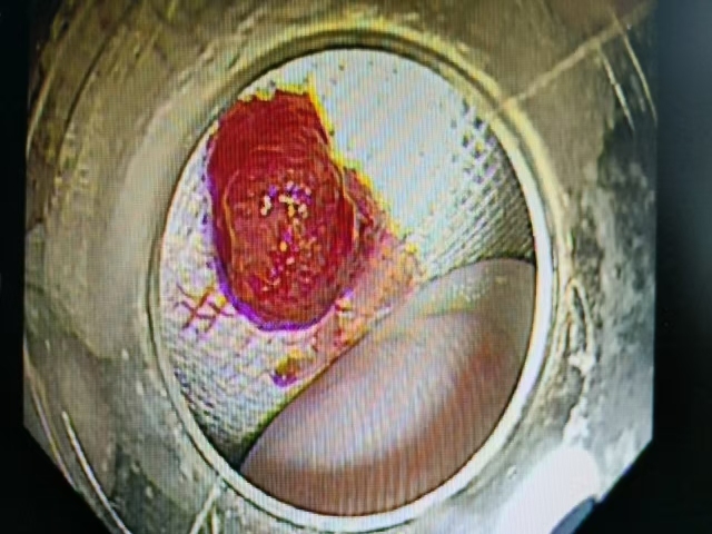 胃增生性息肉