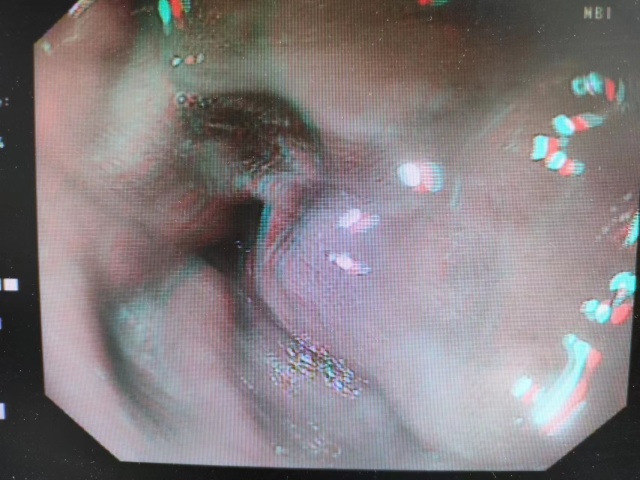 神经内分泌瘤？还是低分化腺癌？