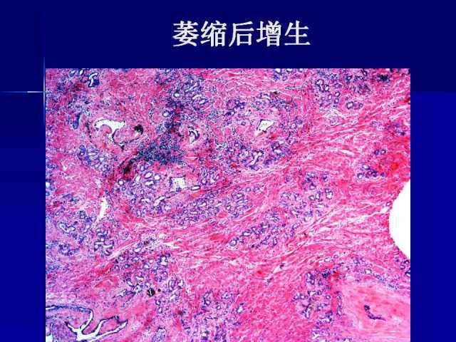 前列腺病理诊断线索（下）——黄教悌