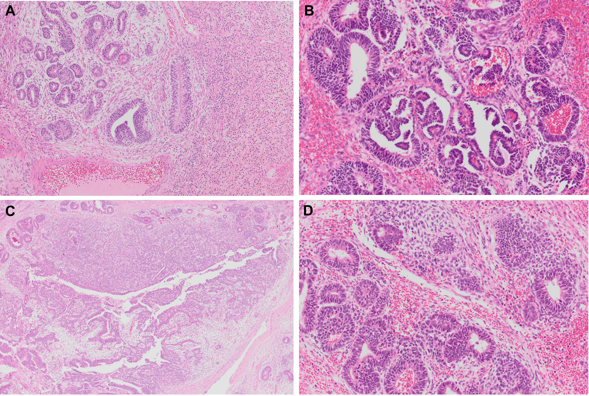 文献速递-DICER1相关的Wilms样肿瘤