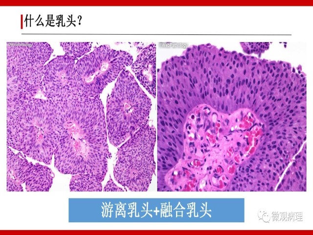 泌尿课程/尿路上皮病变的基本生长方式