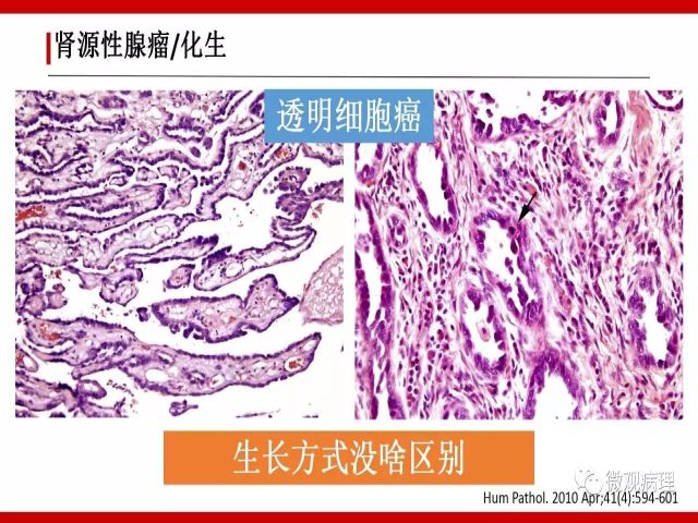 泌尿课程/尿路腺样病变的诊断要点