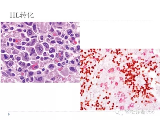 慢性淋巴细胞性白血病