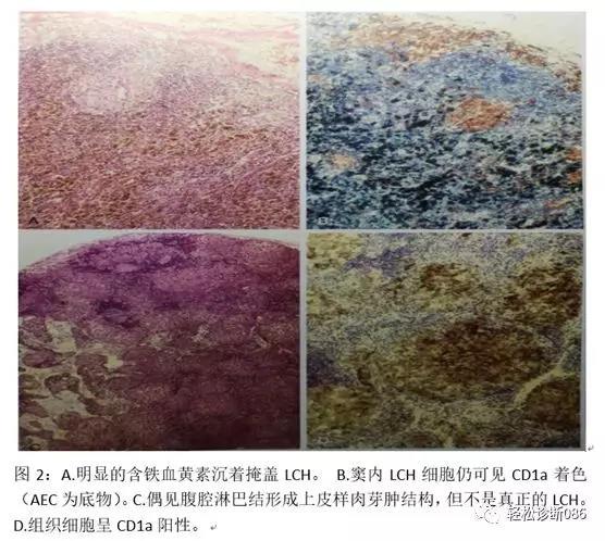 组织细胞起源疾病（4）——肿瘤性病变（LCH）