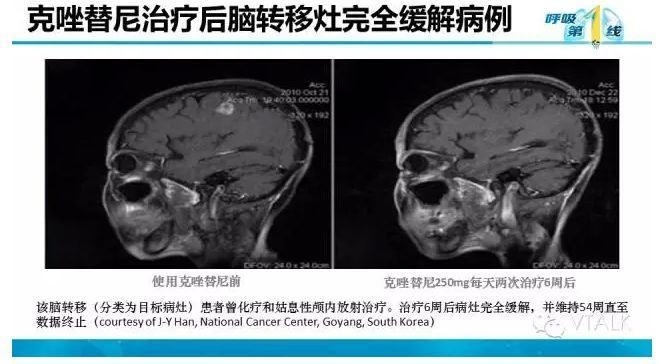 驱动基因阳性NSCLC脑转移：阿克琉斯之踵？