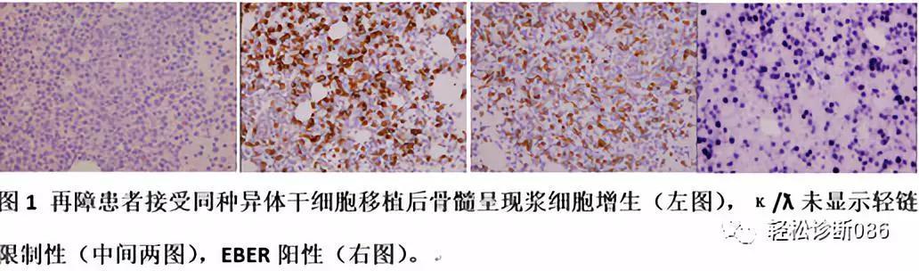 免疫缺陷相关性淋巴组织增殖性疾病（7）