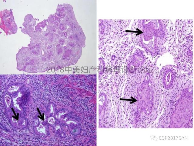子宫内膜假肿瘤性病变及类似癌样病变