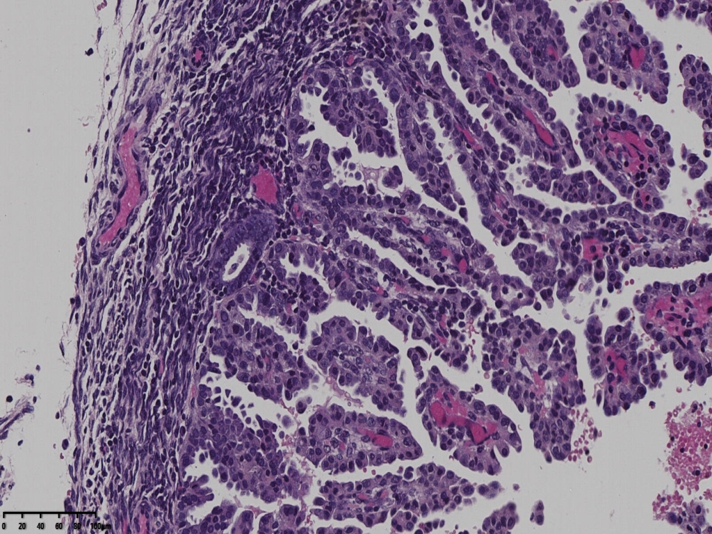 子宫透明细胞癌？