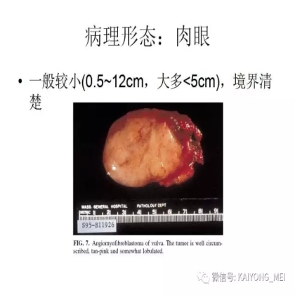 女性生殖道软组织肿瘤病理诊断及进展（二）