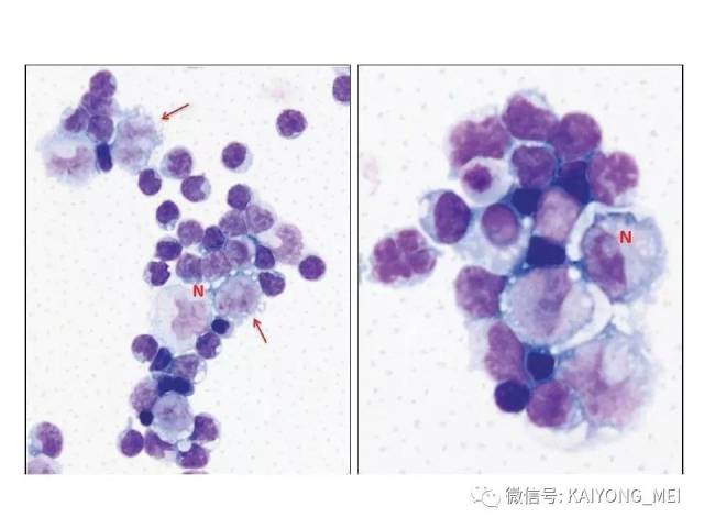 T细胞淋巴瘤病理诊断及进展（二）