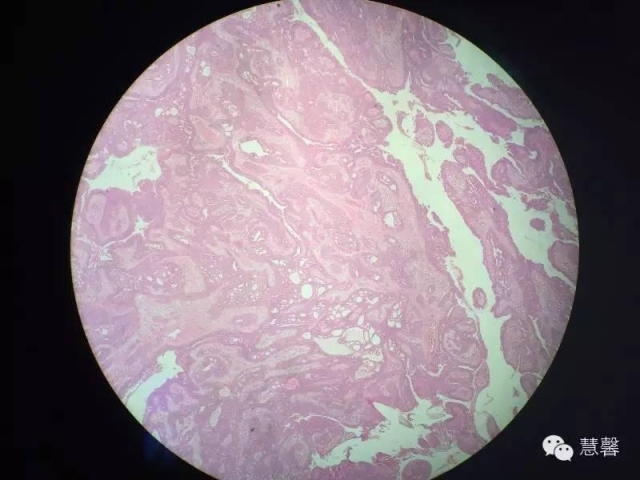 乳头状汗管囊腺瘤诊断及取材相关问题（迟悟分享，孔祥田及于励民老师讲解）