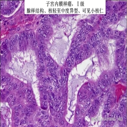 卵巢癌的病理诊断新进展（二）