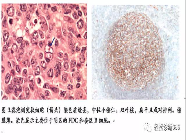 组织细胞起源疾病（1）——概述
