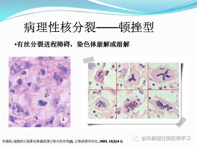 病理学基础知识 : 核分裂像的识别