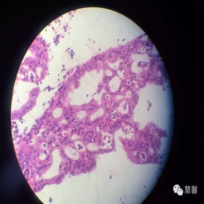 子宫内膜乳头状增生（甜甜分享病例，孔祥田(Max)*Roswell*老师讲解，kent翻译整理文献）