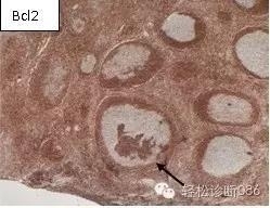 小B细胞NHL——FL（1）